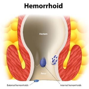 Hemorrhoids or Piles – Symptoms, Causes and Treatment